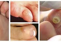 Corns and callus