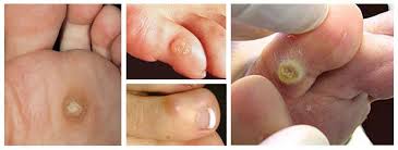 Corns and callus