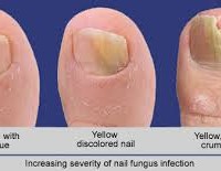 Fungal nail