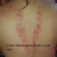 Gua Sha upper back