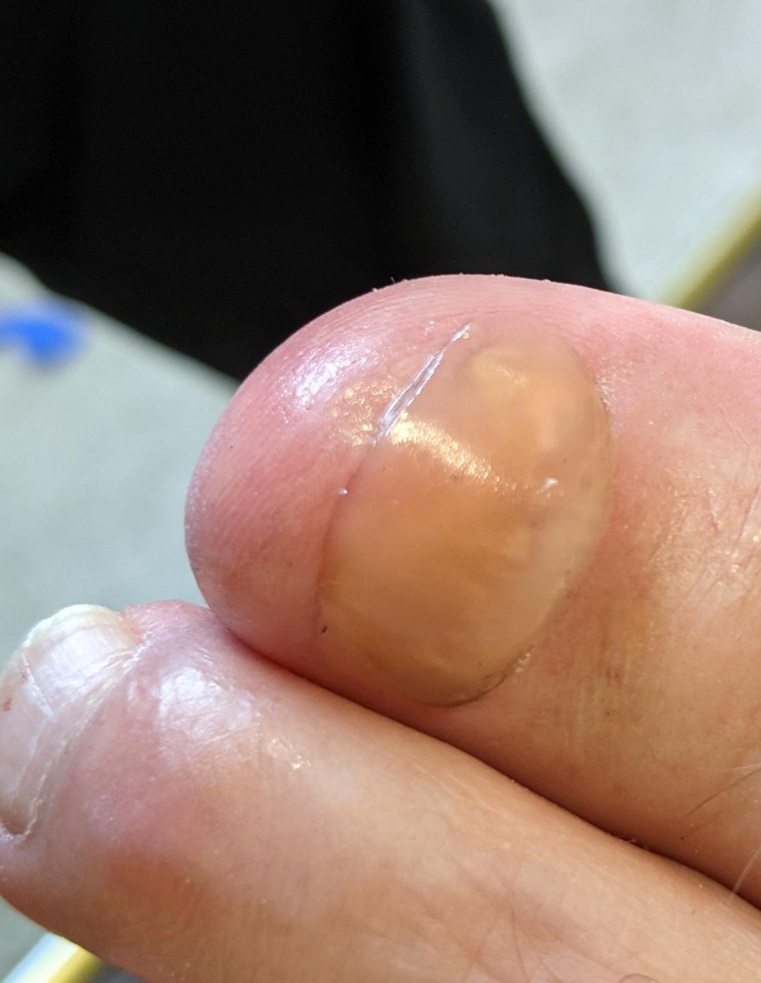 Toe nail reconstruction
