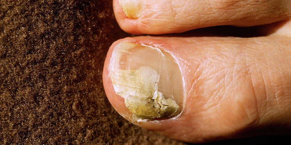 Fungal Nail | Foot Health | Canesten